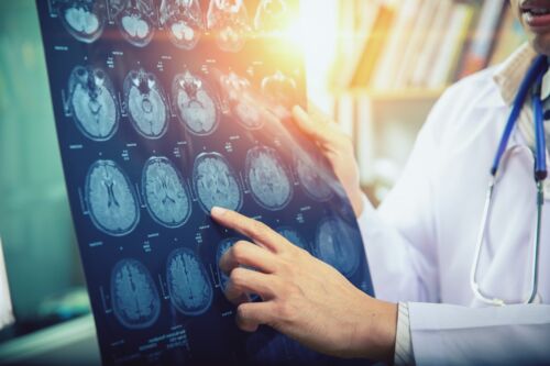 Doctor reviewing MRI (Xray) Brain Scans. Visual concept for a personal injury blog discussing a catastrophic injury.