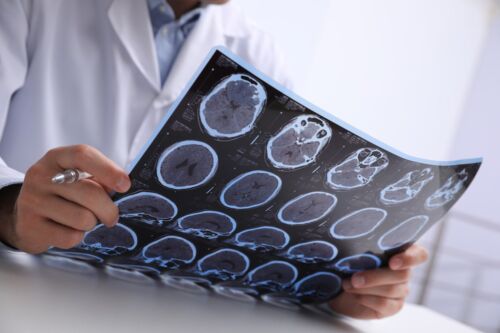 Doctor examining brain scan images. Visual concept for a blog discussing the subtle signs of brain damage after an accident.